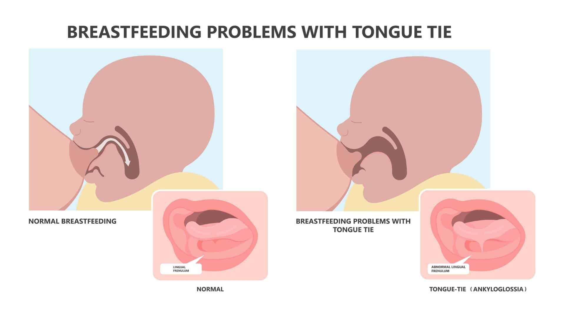 Infografica medica che confronta l'allattamento al seno normale con i problemi causati dal frenulo linguale (anchiloglossia) nel neonato